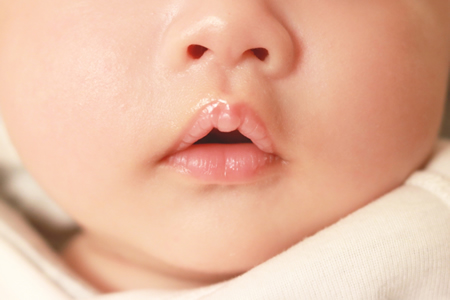 乳児脂漏性湿疹の対策