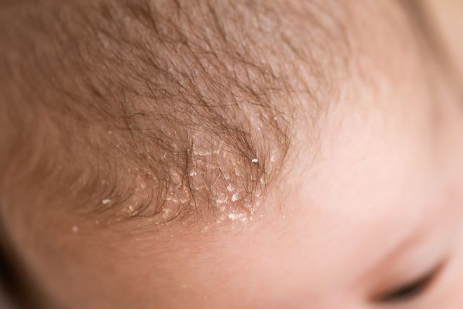 乳児脂漏性湿疹の症状・原因とご家庭でできる対策について