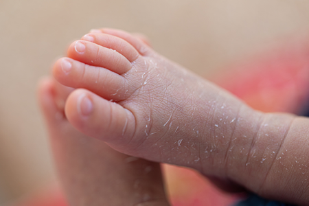 医師監修 乳児湿疹の種類と原因からわかる適切なケア マンビーノ Mambino ドルチボーレ育児メディア