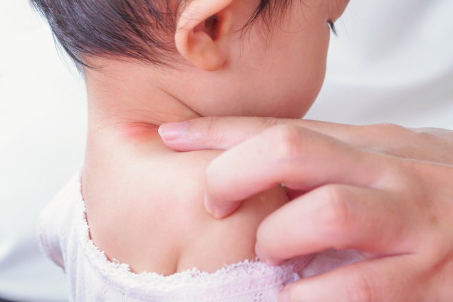赤ちゃんの接触性皮膚炎の原因や症状・対策について